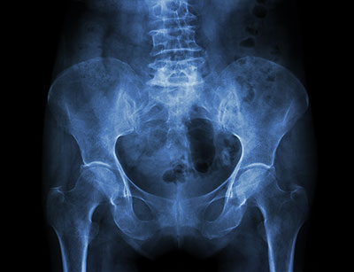 Metal-On-Metal Hip Replacement Implants
