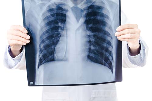 IVC Filter FAQs