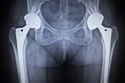 Hip Implant