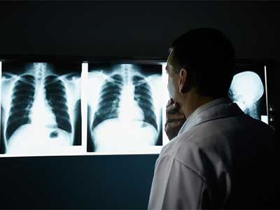 Mesothelioma vs Lung Cancer
