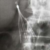 Ivc