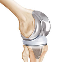 Knee Replacement