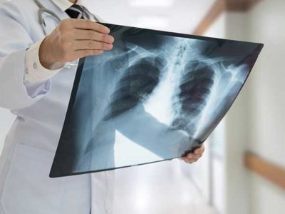 Mesothelioma Diagnosis